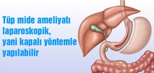 OBEZİTE (AŞIRI ŞİŞMANLIK )VE TÜP MİDE (SLEEVE GASTREKTOMİ )OPERASYONU