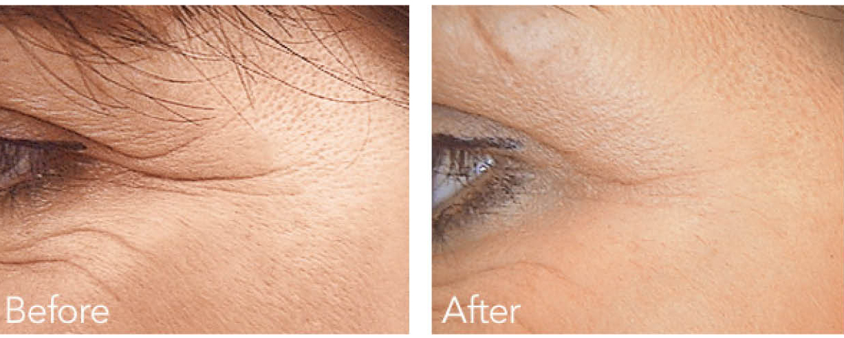 Botox nedir? Kimlere yapılabilir? Yan etkisi var mıdır? Ne zaman yapılmalıdır? Nerelere yapılabilir?