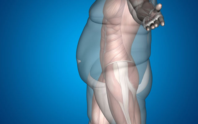 Obezite sonuçları ve obezite cerrahisinin faydaları: gastrik bypass (mide küçültme) ve sleeve gastrektomi (tüp mide) makalesi