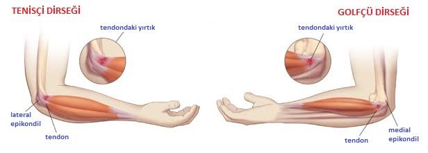 Dirsek; TENİSÇİ ve GOLFÇU DİRSEĞİ