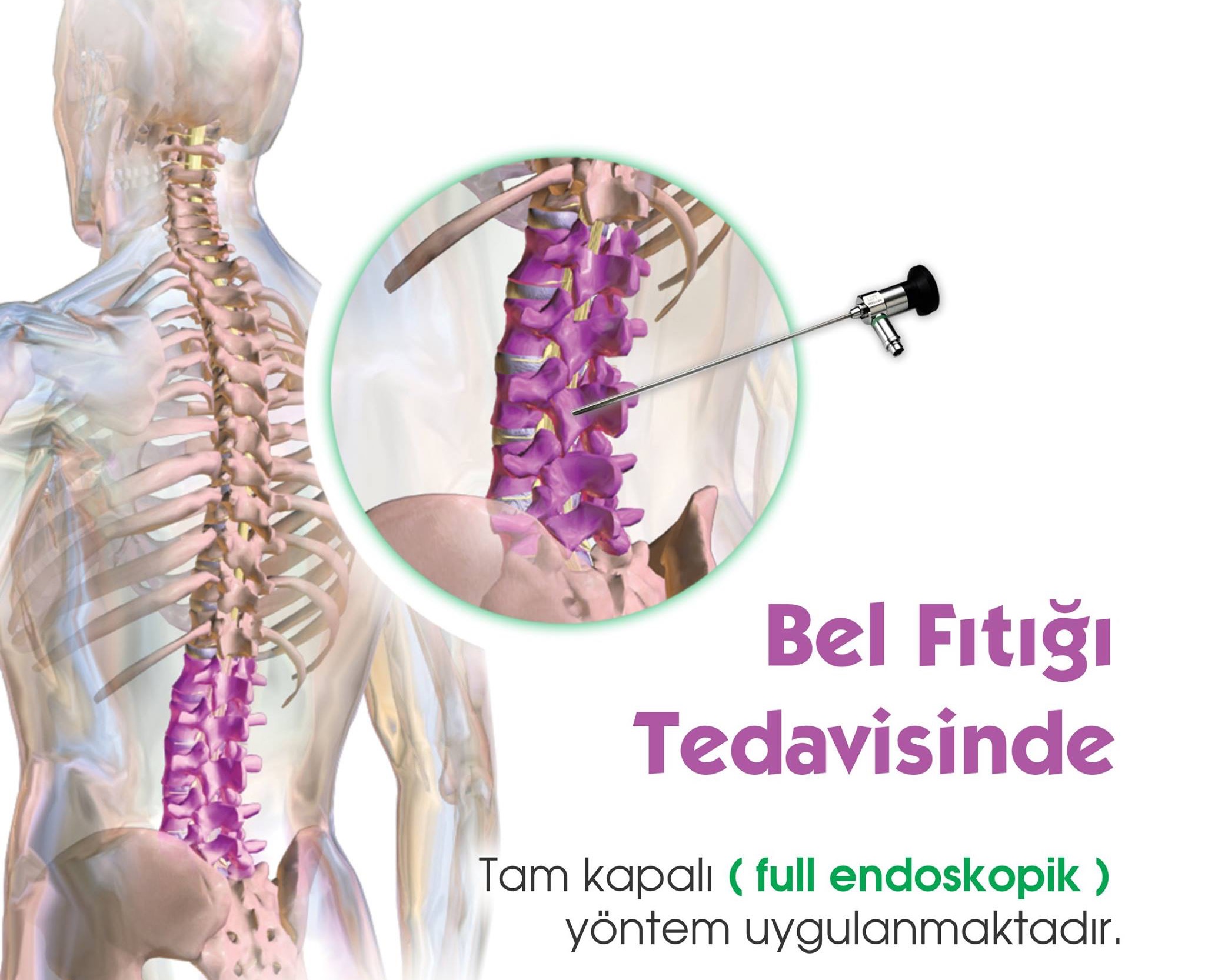 Bel Fıtığında Endoskopik Yöntem