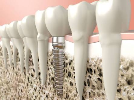 İmplant çürür mü , implant düşer mi ve implant konusunda daha fazla merak ettiğiniz tüm cevaplar