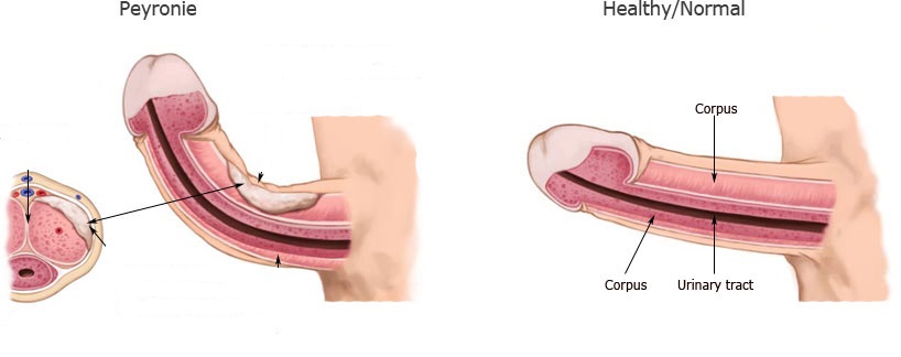 Penis eğiriliği tedavisi mümkün olan bir durumdur
