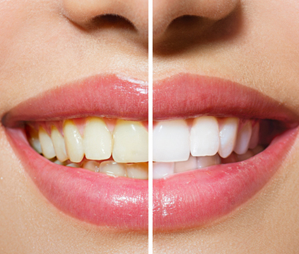 DİŞ BEYAZLATMA İLE İLGİLİ SIKÇA SORULAN SORULAR