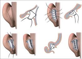 Otoplasti - Kepçe Kulak