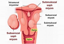 Miyomlar ve infertilite makalesi