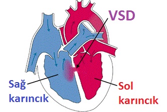 Çocuklarda görülen kalp hastalıkları nelerdir?