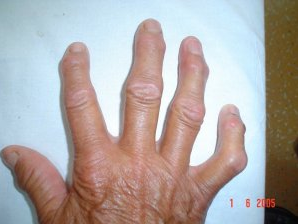 OSTEOARTRİT; KİREÇLENME MECBURİ BİR KADER MİDİR?