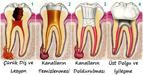 İnatçı Enfeksiyonlar Kanal Tedavisi ve Apikal Rezeksiyon makalesi