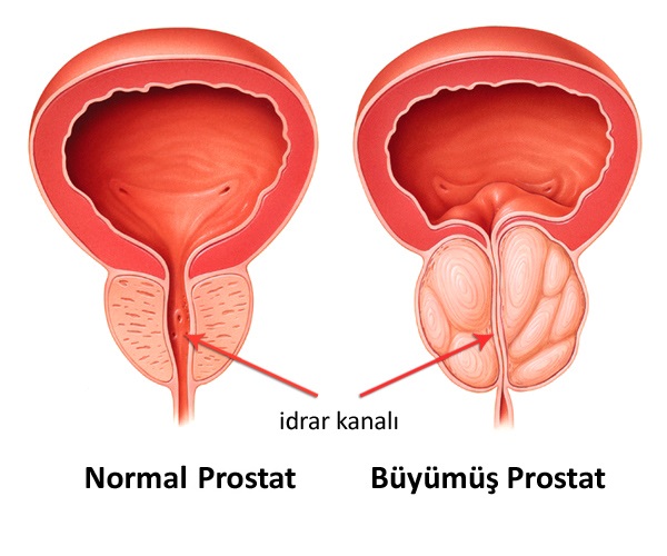 BPH (İyi Huylu Prostat Büyümesi) makalesi