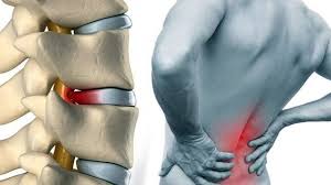 Bel Fıtığı Ve Tedavisi Hakkında