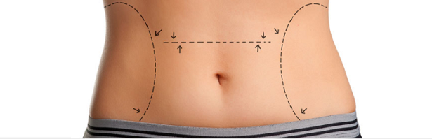 Karın Germe (ABDOMİNOPLASTY) Operasyonu Hakkında makalesi