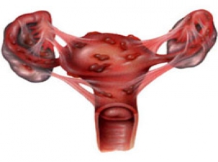 ÇİKOLATA KİSTİ ENDOMETRİOMA SİZİ KORKUTMASIN