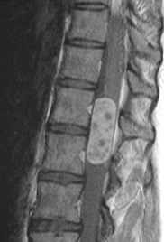 Omurilik Tümörleri Hakkında