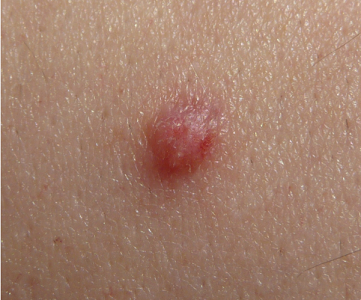 Genital Siğil Tedavisi