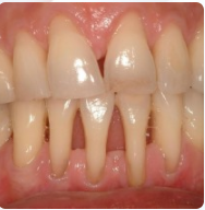 Diş Eti Çekilmesi, Diş Eti Kanaması (Periodontoloji)