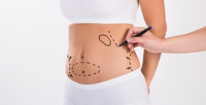 Karın germe veya Abdominoplasti