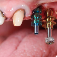 Implant nedir? Implant tedavisi ne kadar sürer? Herkes yaptırabilir mi? Vücut tarafından reddedilme riski var mıdır? Nelere dikkat etmek gerekir? Yapılan ımplant tedavisinin ömrü ne kadardır? makalesi