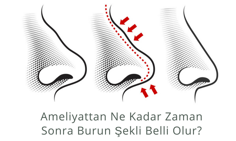 Ameliyattan Ne Kadar Zaman Sonra Burun Şekli Belli Olur?