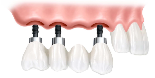 kısaca dental implant