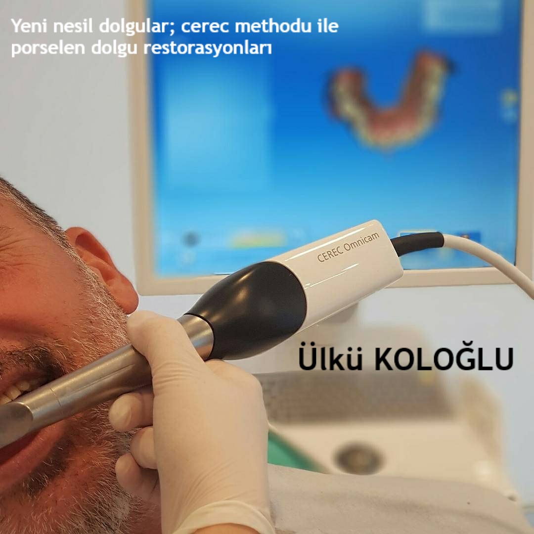 Yeni Nesil Dolgular; CEREC Methodu ile Porselen Dolgu Restorasyonları