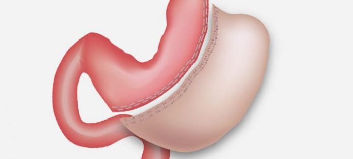 Obezite cerrahisinde tedavi seçenekleri makalesi