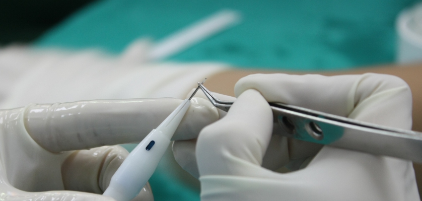 Kellik (Androgenetik alopesi) ve DHI ( Kalem tekniği) ile Saç ekimi