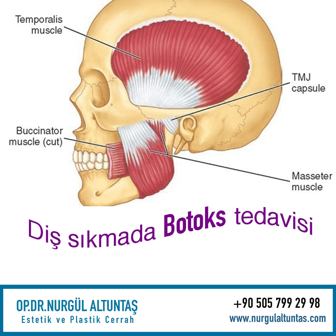 Diş Sıkma (Masseter) botoksu nedir?
