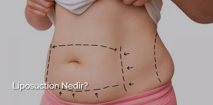 Liposuction ve Liposuction Olurken Bilinmesi Gerekenler! makalesi