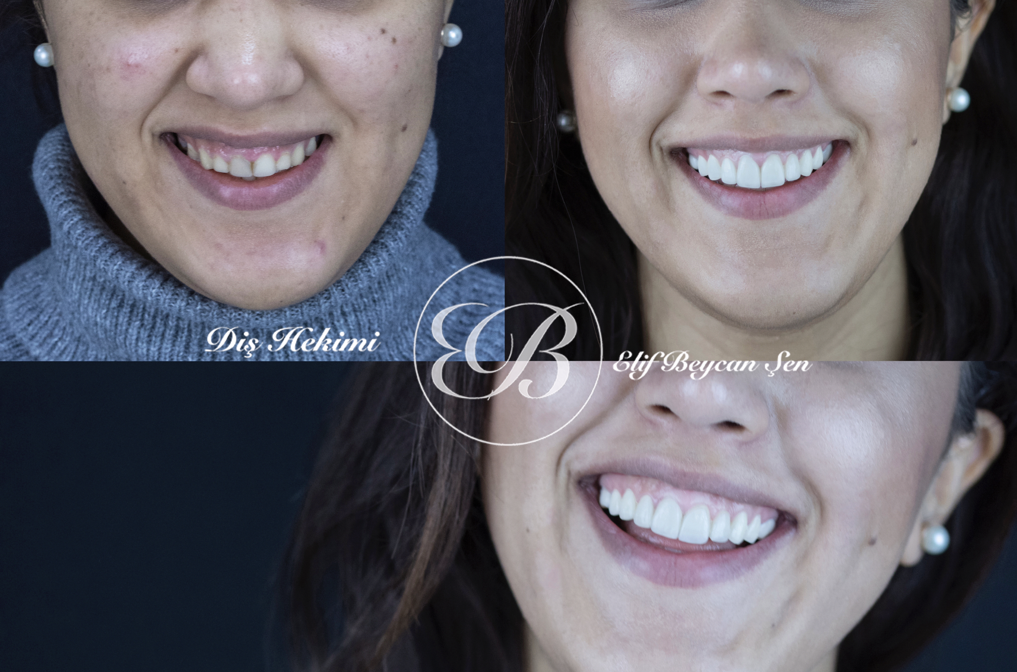 Gülüş tasarımı (smile design,gülüş estetiği) nedir?