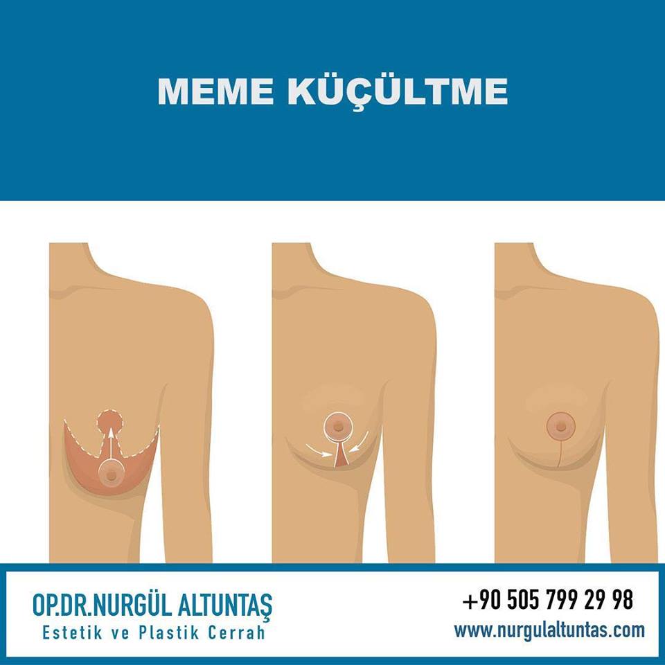 MEME KÜÇÜLTME AMELİYAT ÜCRETLERİ NASILDIR?