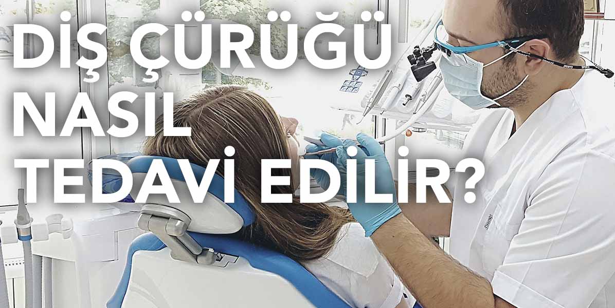 Diş çürüğü nasıl tedavi edilir?