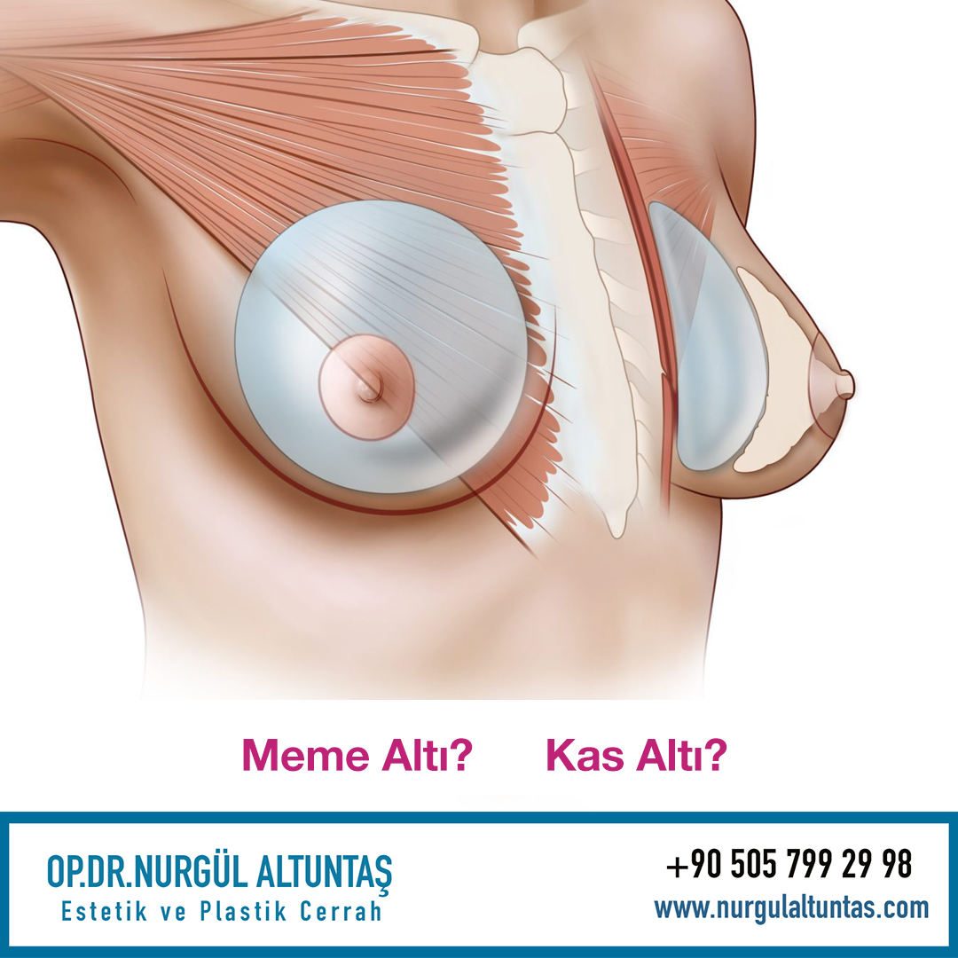 Meme Büyütme Nasıl Uygulanır?