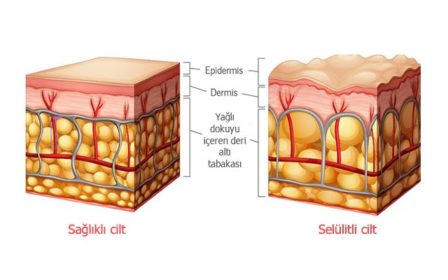 SELÜLİT NEDİR? NEDEN OLUŞUR?