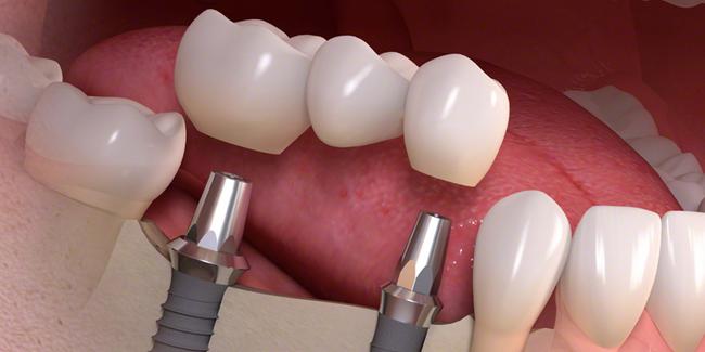 Dental İmplant Diş Tedavisinin Avantajları Nelerdir ?