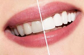 Diş Beyazlatma / Bleaching İşlemi makalesi