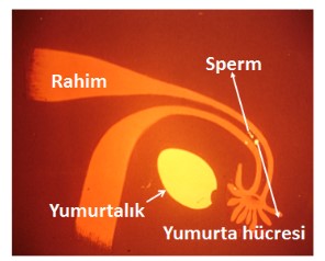 Halk arasında İnfertilite: Kısırlık