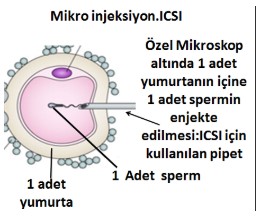 Tüp Bebek (IVF: In Vitro Fertilizasyon)