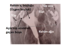 HSG (Histero-Salpingo-Grafi):