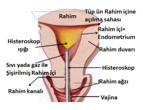 Histeroskopi nedir? Hangi konularda kullanabiliriz?