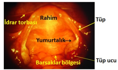 Laparoskopi nedir ? Hangi operasyonlar başarı ile yapılabilir?