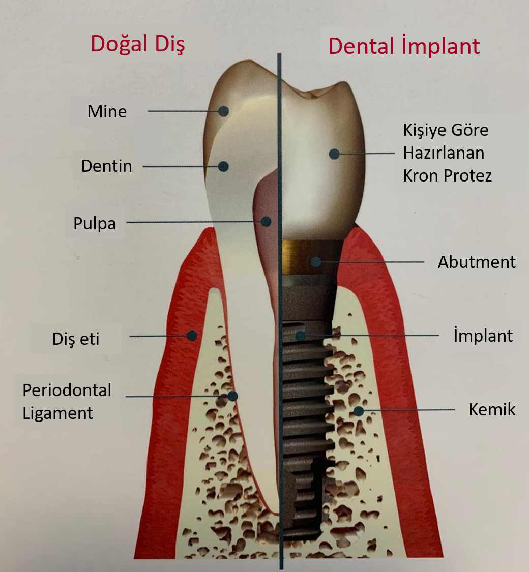 Eksik diş ve diişlerin yerine implant makalesi