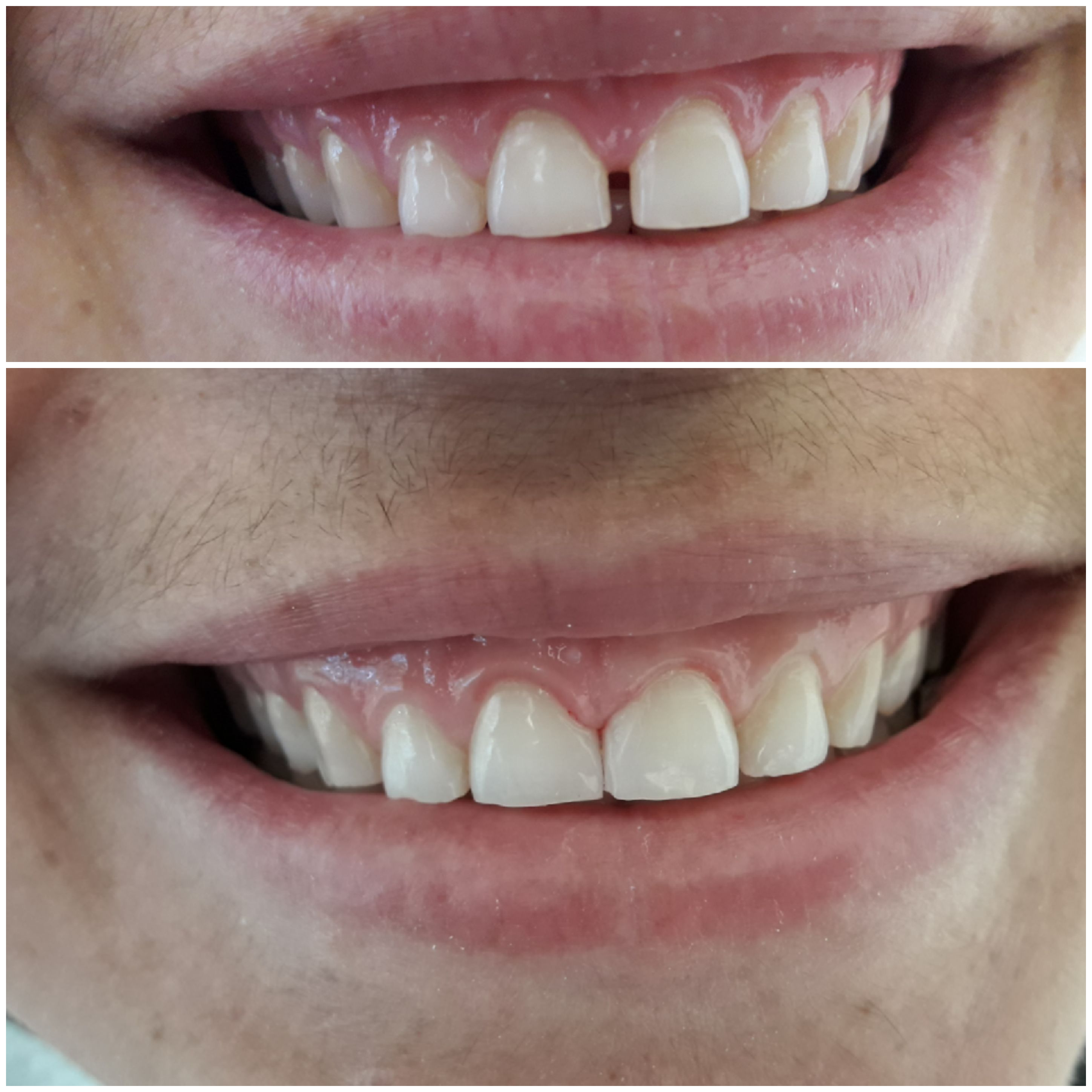 Diastema makalesi