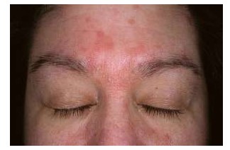 Sık görülen bir deri hastalığı: Seboreik Dermatit!