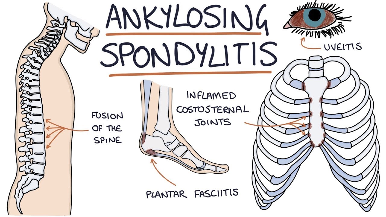 ANKİLOZAN SPONDİLİT HAKKINDA BİLİNMESİ GEREKENLER