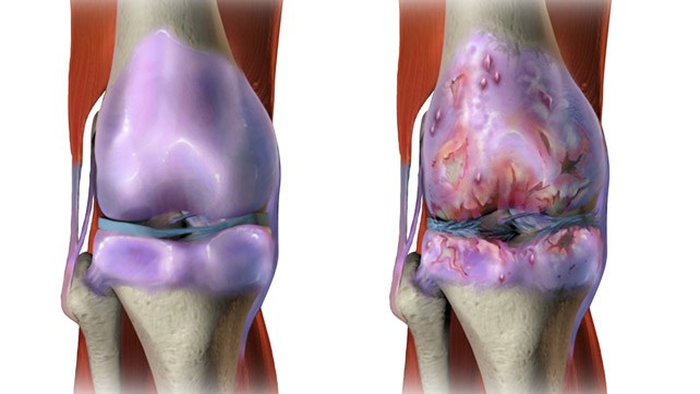 OSTEOARTRİT (EKLEM KİREÇLENMESİ)