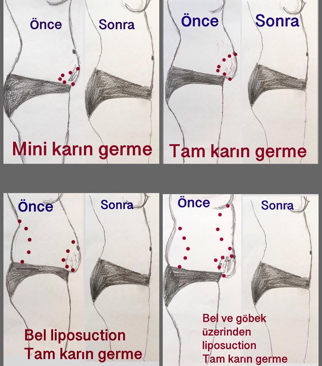 Karın Germe Operasyonu Hakkında Sık Sorulan Sorular