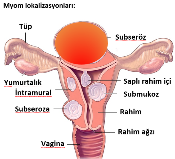 Myom(Fibrom) makalesi