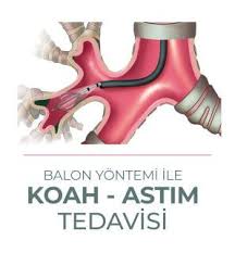 KOAH BALON TEDAVİSİ VE YARARLARI