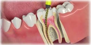 Kanal Tedavisi (Endodonti) Nedir, Nasıl Yapılır? makalesi